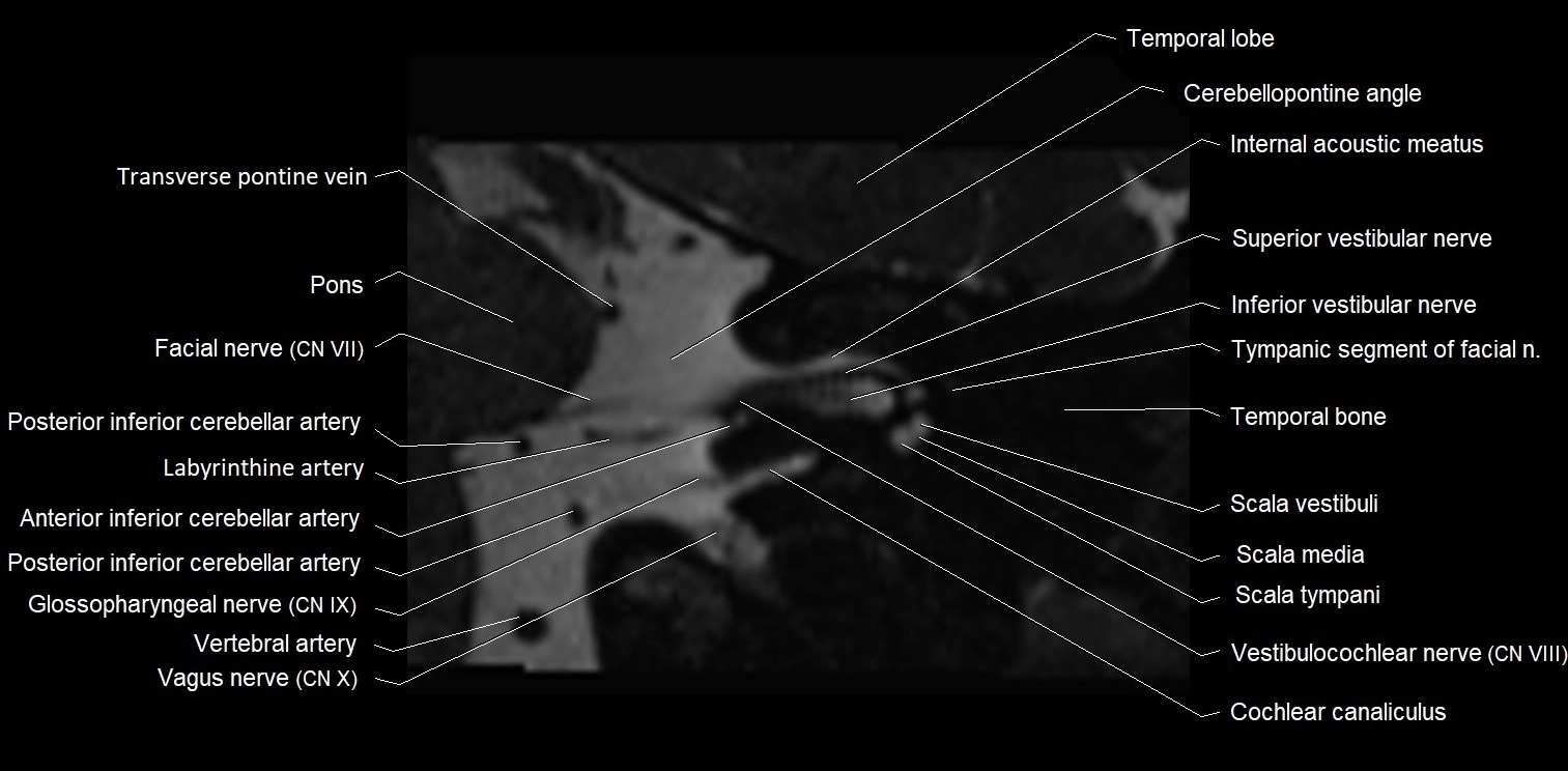 MRI Internal auditory meatus (IAM) coronal cross sectional labelled anatomy image 13.webp